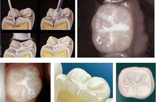 invasive minimally dentist cavities teeth early cavity detected placed fillings drilling because were